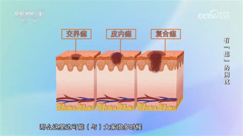 突出來的痣|身上的痣能抠吗？凸起的痣和平平的痣哪个更易恶。